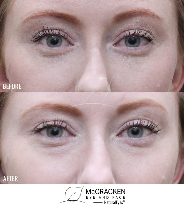 28 Year Old Female – Lower Blepharoplasty. No Skin Incisions.