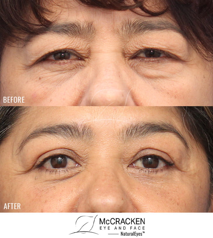 60 Year Old Female – Upper and Lower Blepharoplasty. A lower lid skin muscle flap was used.
