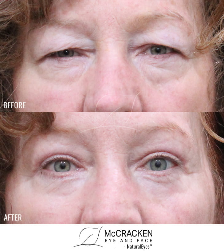 64 Year Old Female – Upper blepharoplasty, Transconjunctival Lower Blepharoplasty with lower lid skin excision, Periocular Fractional CO2 Laser Skin Resurfacing.