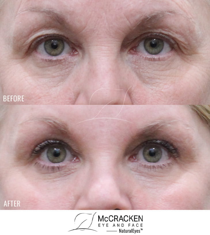 52 Year Old Female – Upper and Lower Blepharoplasty with Full Face Erbium Laser Skin Resurfacing.