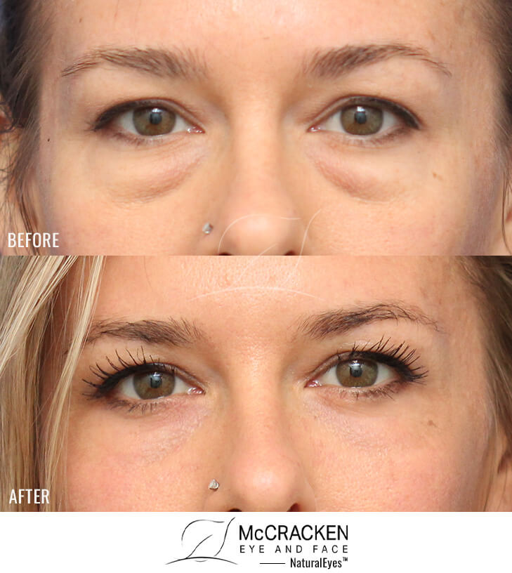 39 Year Old Female Lower Blepharoplasty with Periocular Laser Skin Resurfacing. No lower lid skin incisions were made.