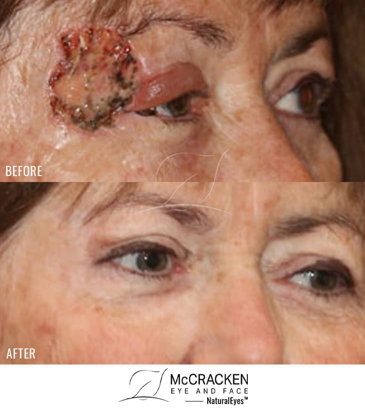 66 year old female – Repair of right temple defect after excision of Malignant Melanoma in Situ.