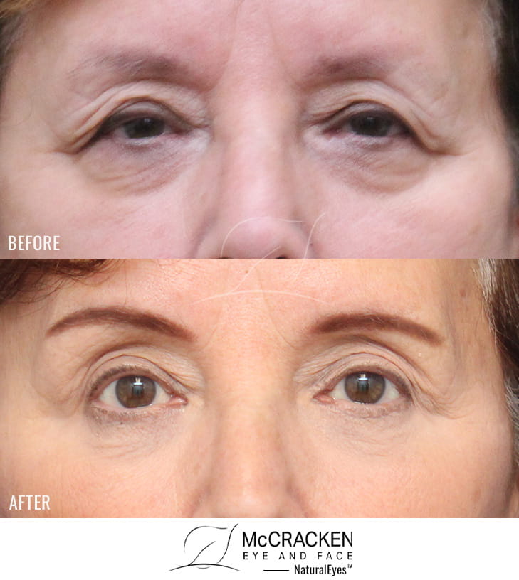 69 Year Old Female – Upper and Lower Blepharoplasty with Bilateral Upper Lid Ptosis Repair, Bilateral Temporal Brow Lift, and Periocular Laser Skin Resurfacing. No lower lid skin incisions were made.