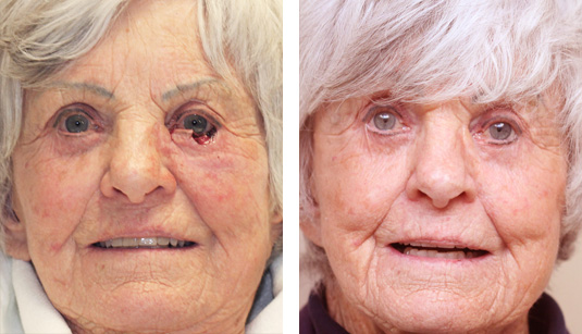  Before and After Picture 
81 year old female - Repair of left lower lid Mohs defect after excision of basal cell carcinoma