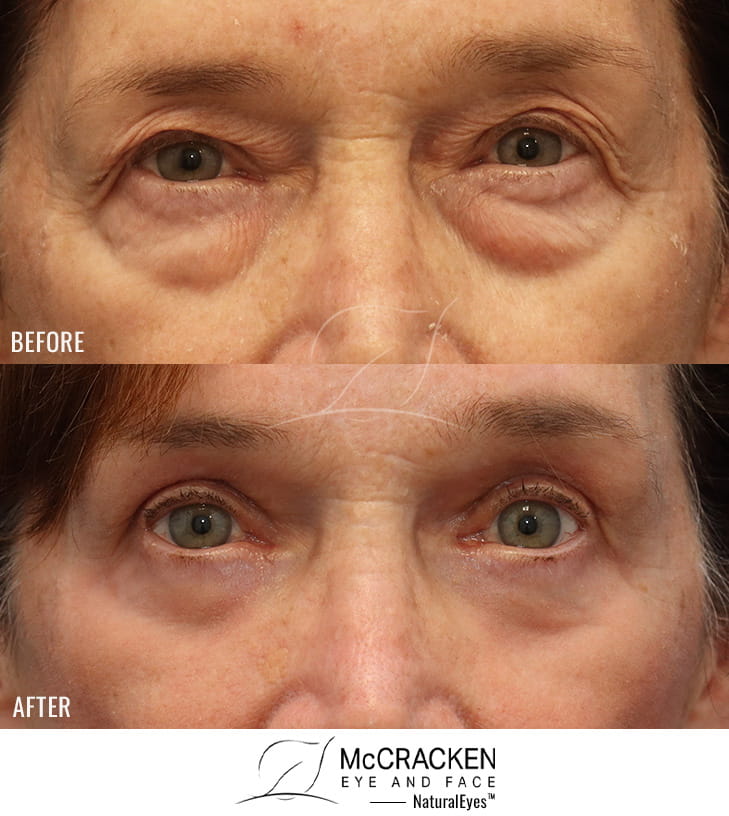 66 Year Old Female – Upper and Lower Blepharoplasty with Right Brow Pexy and Laser Skin Resurfacing. No lower lid skin incisions were made.