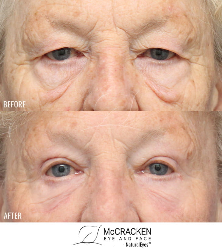 73 Year Old Female – Upper and Lower Blepharoplasty with Direct Excision of Festoons and Periocular Laser Skin Resurfacing. Because this patient had festoons (folded over skin and muscle on the cheek just below the lower lid) she had excision of the redundant tissue below the lower lid.