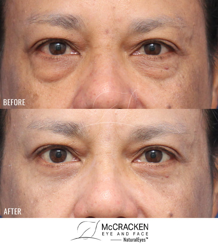 53 Year Old Female – Lower Blepharoplasty. No lower lid skin incisions were made.