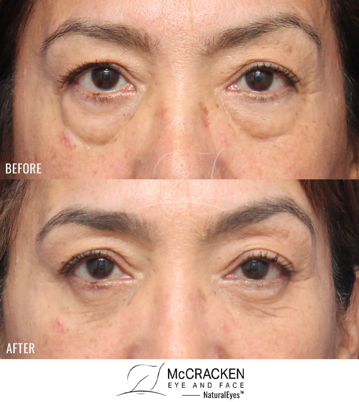 60 Year Old Female – Lower Lid Blepharoplasty with Injection of 4.0cc of Fat to Each Cheek. No Lower Lid Skin Incisions were made.