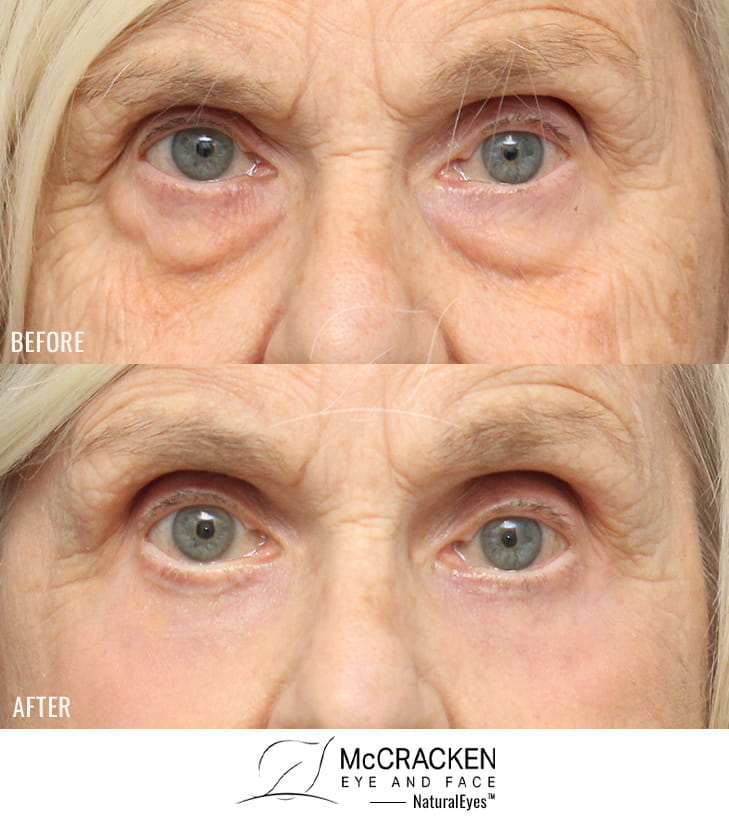 79 Year Old Female – Lower Blepharoplasty with Periocular Laser Skin Resurfacing and Morpheus8 to the Cheeks. No lower lid skin incisions were made.