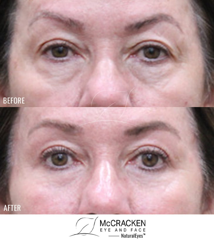 60 Year Old Female – Mid-Facelift with upper and lower blepharoplasty, and Periocular Laser Skin Resufacing. The Mid-Facelift was performed through incisions in the mouth and temples, without any skin incisions.