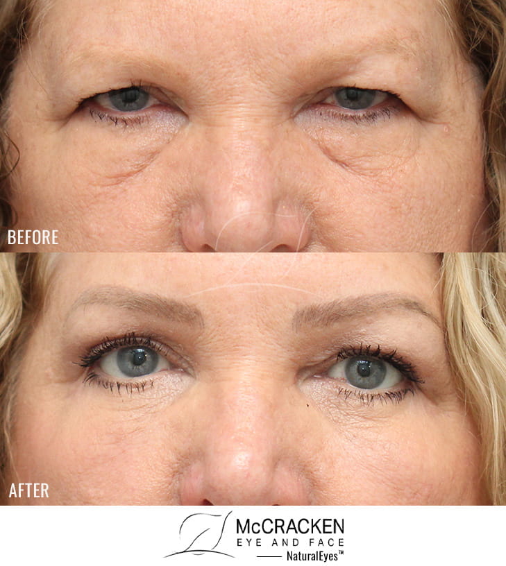 65 Year Old Female – Bilateral Endoscopic Brow Lift with Upper and Lower Lid Blepharoplasty with Laser Skin Resurfacing. The brow lift was fixated with EndoTines and the lower lid blepharoplasty was performed with a skin muscle flap.