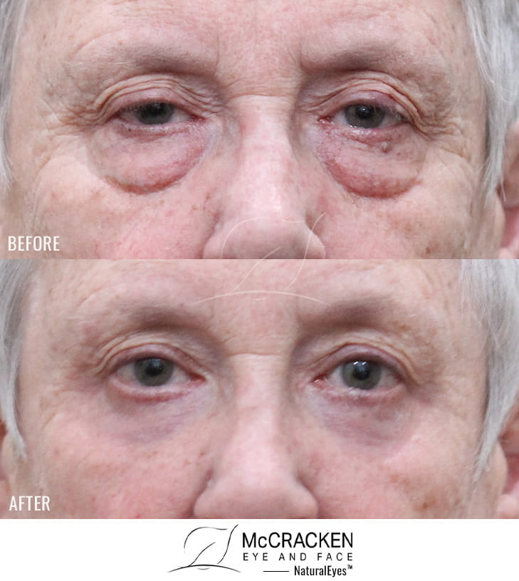 74 Year Old Female – Bilateral Upper Lid Ptosis Repair with Lower Blepharoplasty and Periocular Laser Skin Resurfacing. No Skin Incisions.