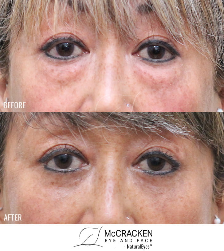 61 Year Old Female – Lower Blepharoplasty