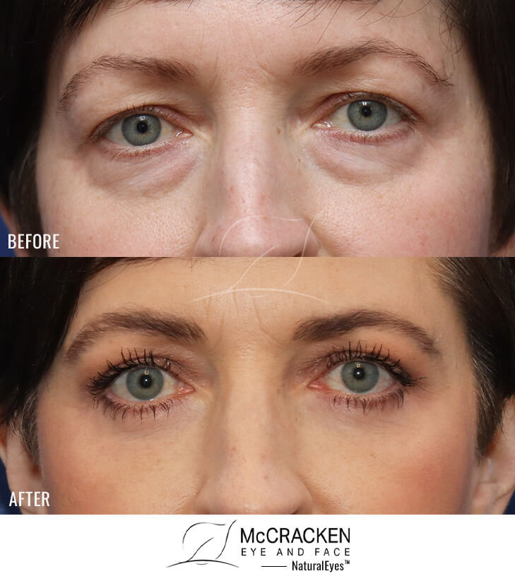 49 Year Old Female Upper and Lower Blepharoplasty with Periocular Laser Skin Resurfacing. No lower lid skin incisions were made.