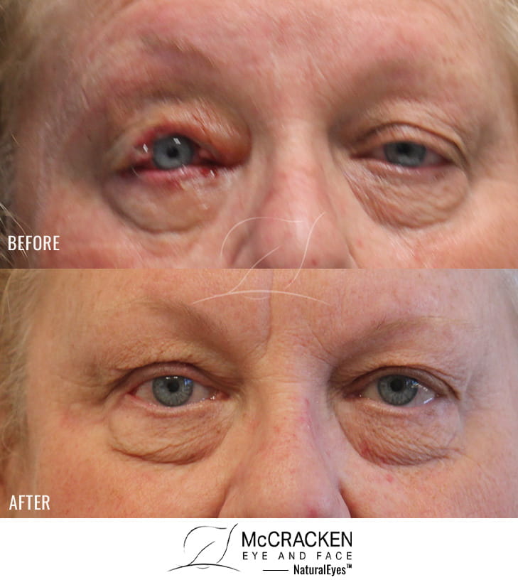 61 year old female – Repair of left lower lid Mohs defect after excision of sweat gland neuroendocrine carcinoma.