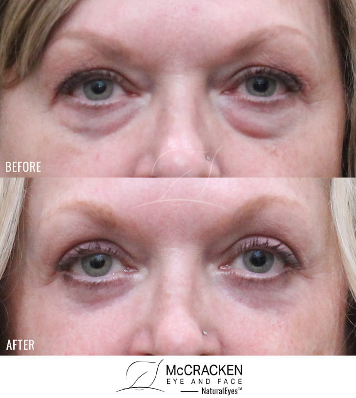 53 Year Old Female – Upper blepharoplasty, Transconjunctival Lower Blepharoplasty, Periocular Fractional CO2 Laser Skin Resurfacing.
