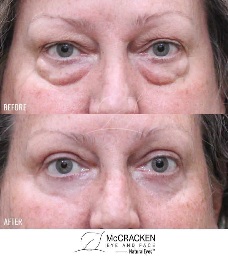 60 Year Old Female – Upper and Lower Blepharoplasty with Laser Skin Resurfacing