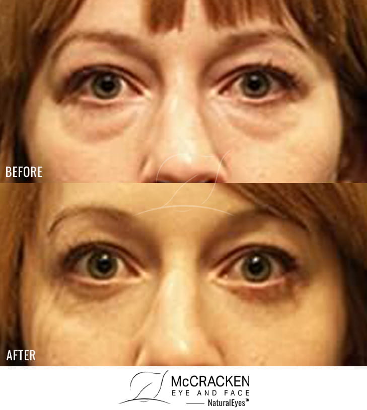 31 year old female – Lower Blepharoplasty