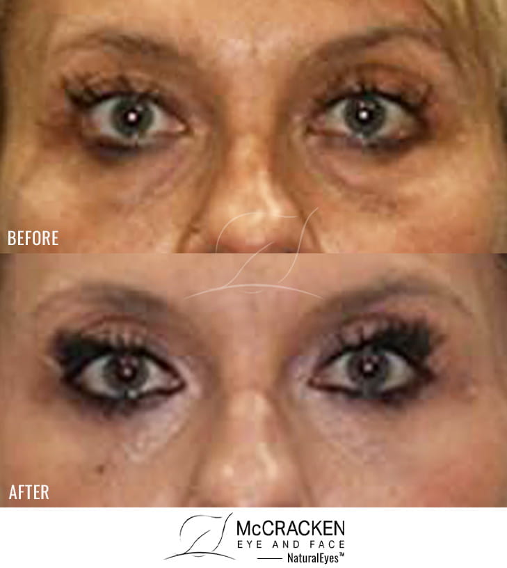 45 Year Old Female: Lower Blepharoplasty with Periocular Laser Skin Resurfacing