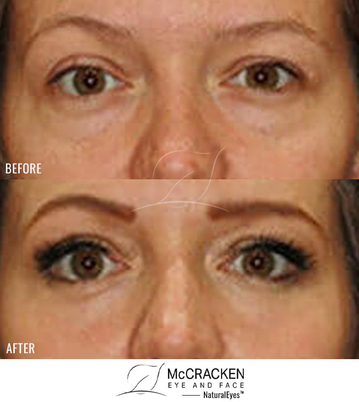 36 Year Old Female – Lower Blepharoplasty with Periocular Laser Skin Resurfacing
