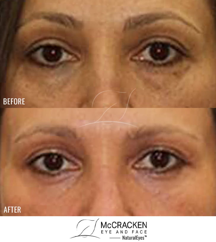 46 Year Old Female – Lower Blepharoplasty with Periocular Laser Skin Resurfacing