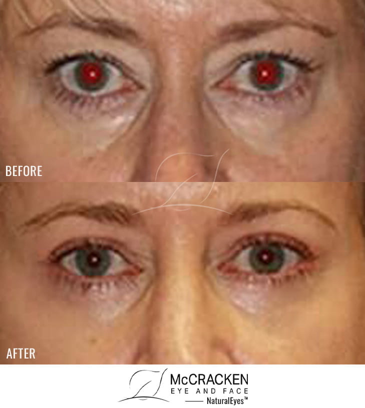 45 Year Old Female: Lower Blepharoplasty with Periocular Laser Skin Resurfacing