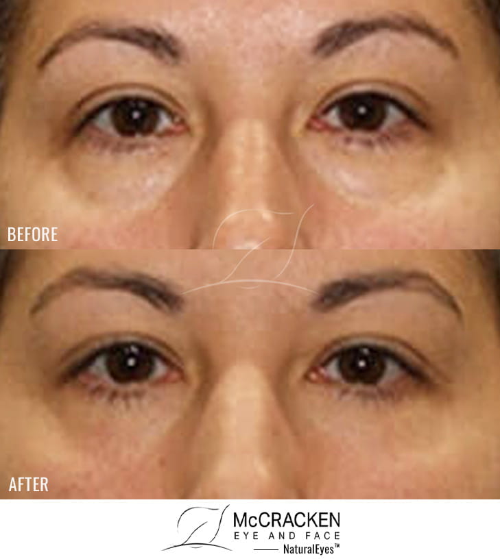 42 Year Old Female – Lower blepharoplasty with Periocular Laser Skin Resurfacing