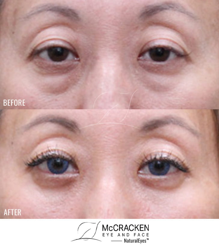 41 Year Old Female – Lower Blepharoplasty with Transconjunctival Fat Repositioning and No Skin Incision