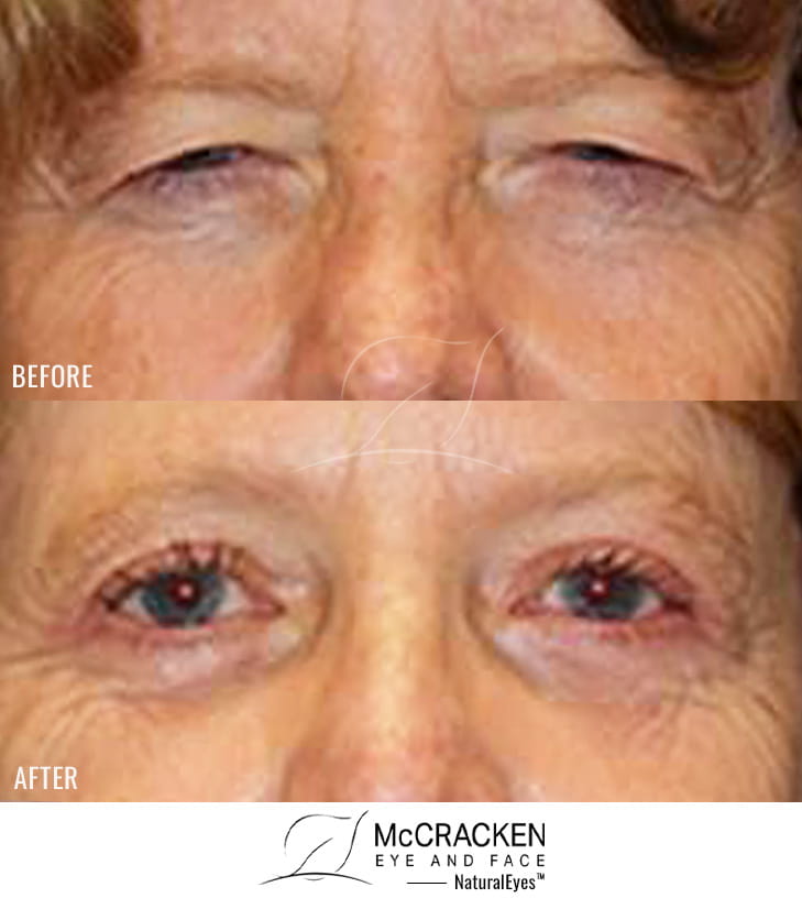 59 Year Old Female – Brow Lift with Upper and Lower Blepharoplasty