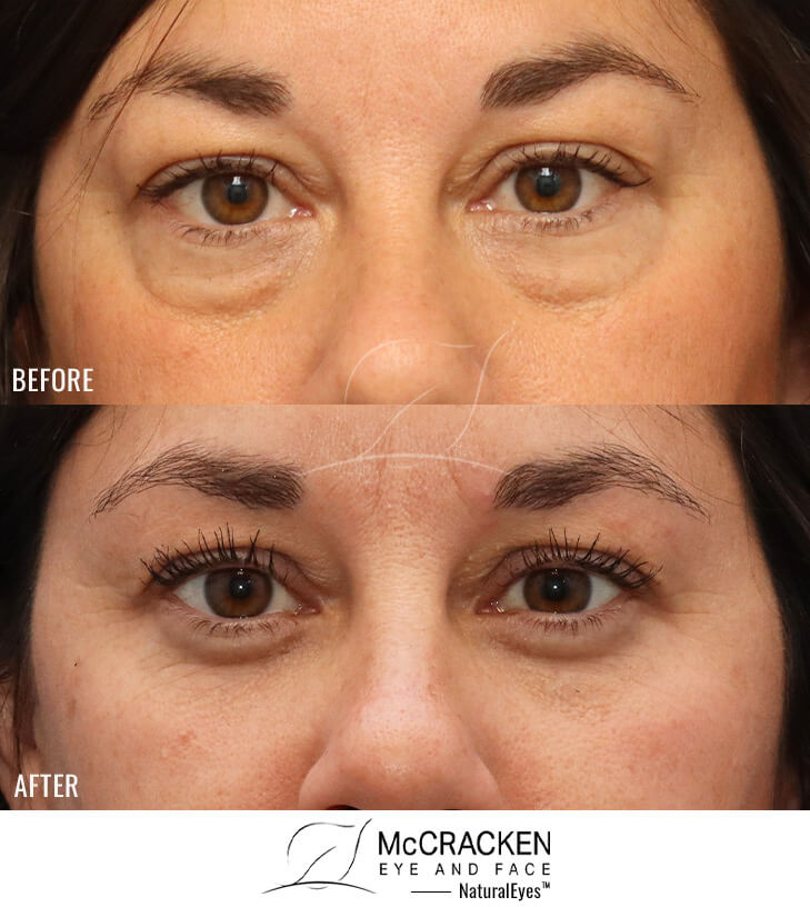 42 Year Old Female Lower Blepharoplasty with AccuTite Radiofrequency Treatment. No lower lid skin incisions were made.
