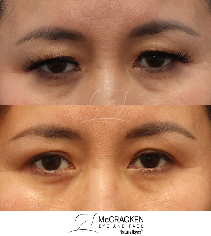 47 year Old Female – Upper Blepharoplasty