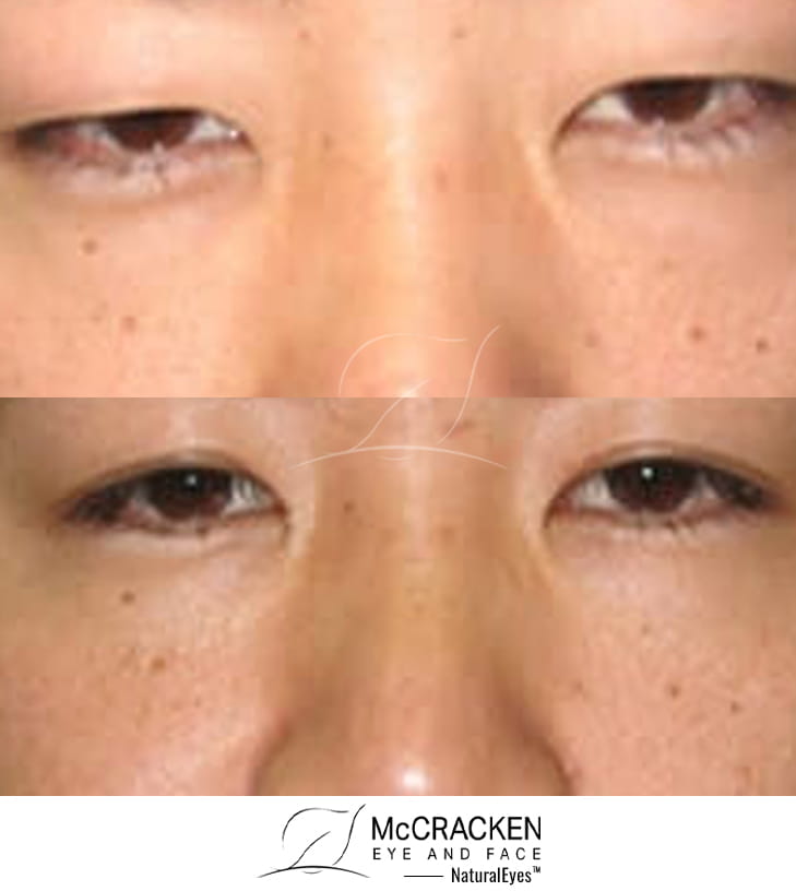 32 Year Old Male – Upper Blepharoplasty