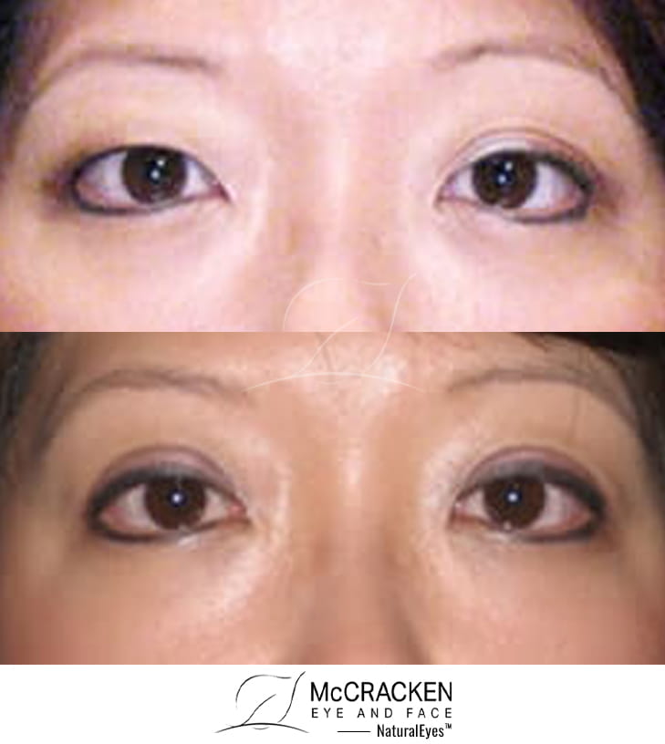 38 Year Old Female – Upper Blepharoplasty