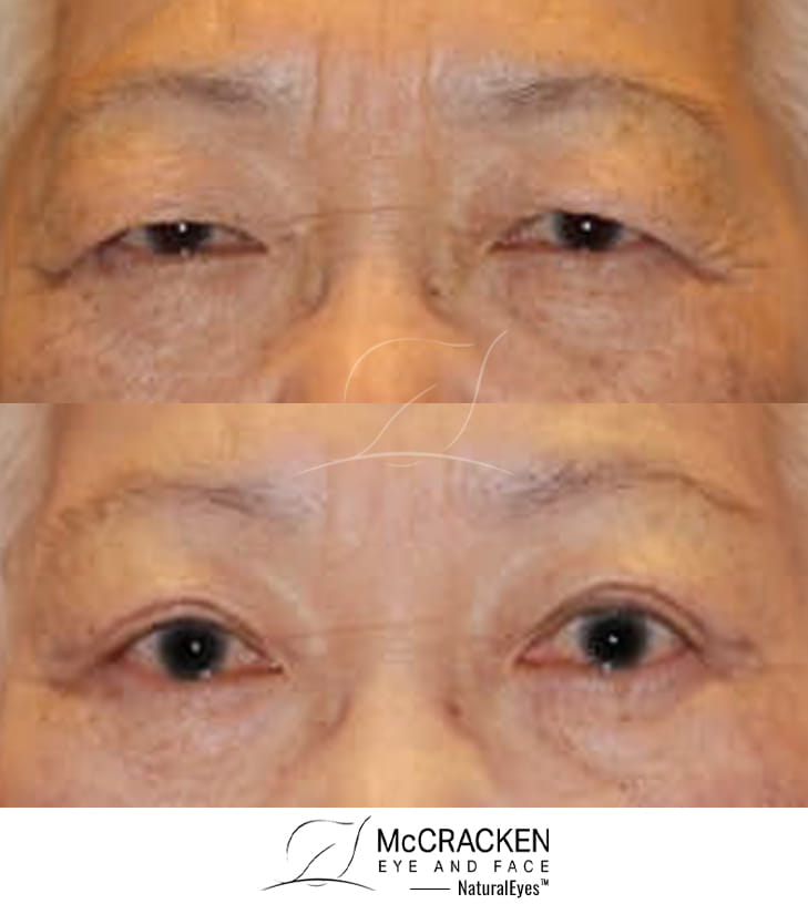 83 year old female – Upper Blepharoplasty