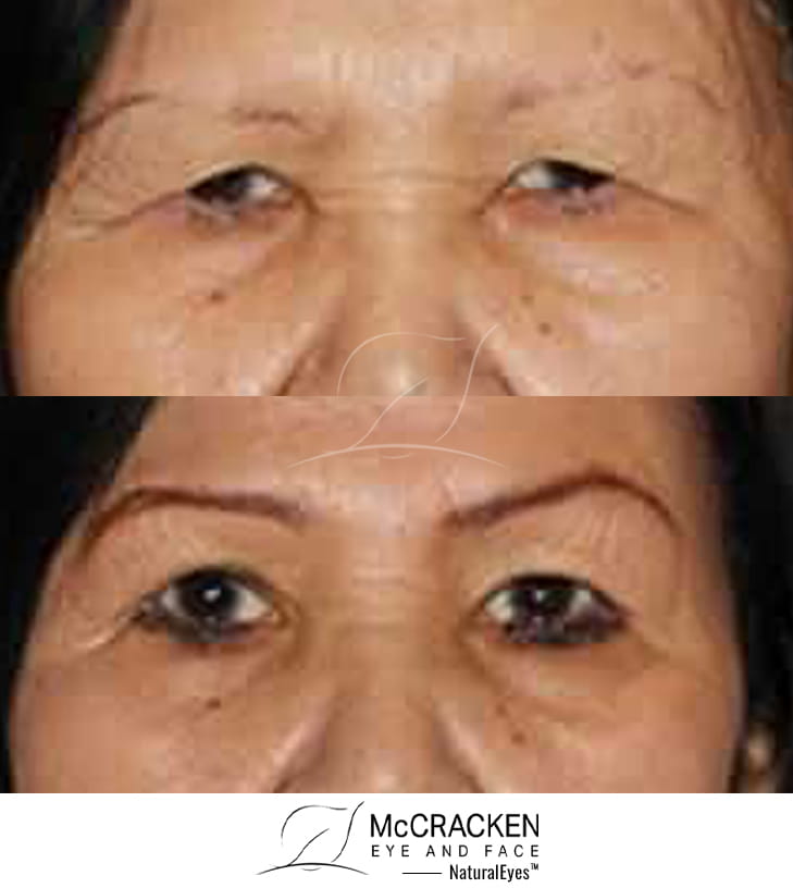 67 Year Old Female Upper Blepharoplasty