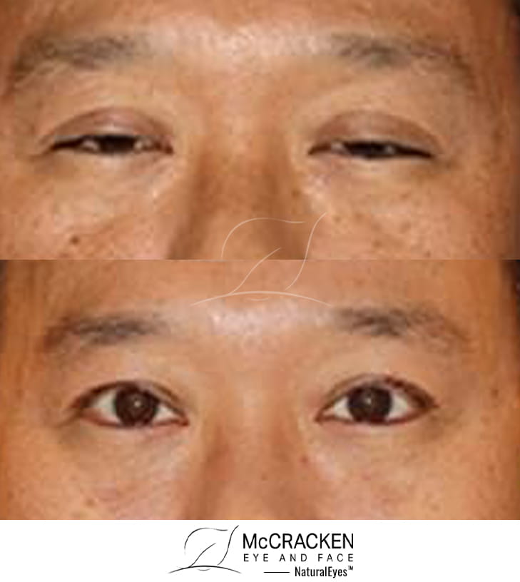 48 Year Old Male Upper Blepharoplasty and Bilateral Upper Lid Ptosis Repair