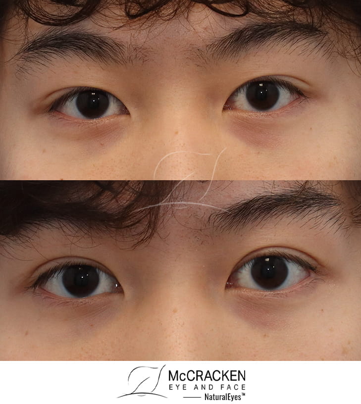 22 Year Old Male – Upper Blepharoplasty