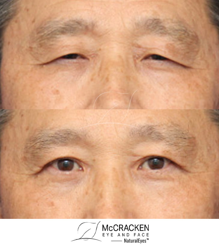 57 Year Old Male – Upper Blepharoplasty