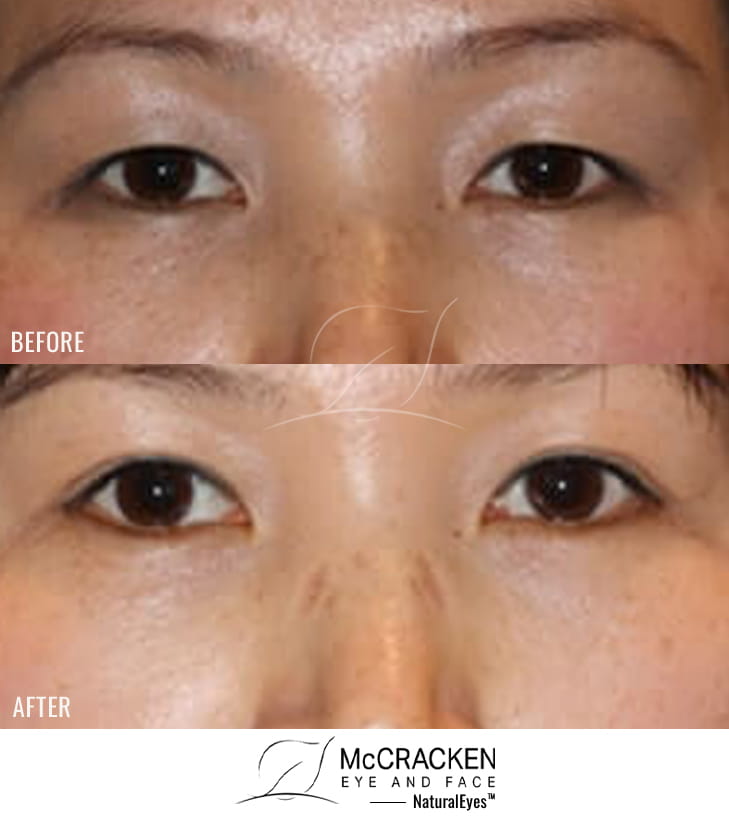 23 Year Old Female – Upper Blepharoplasty