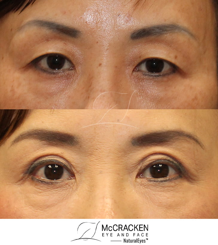 50 year old female. Bilateral upper blepharoplasty