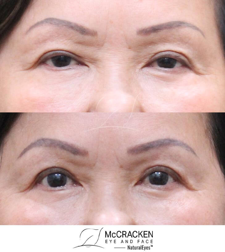 68 Year Old Female – Upper Blepharoplasty and Upper Lid Ptosis Repair