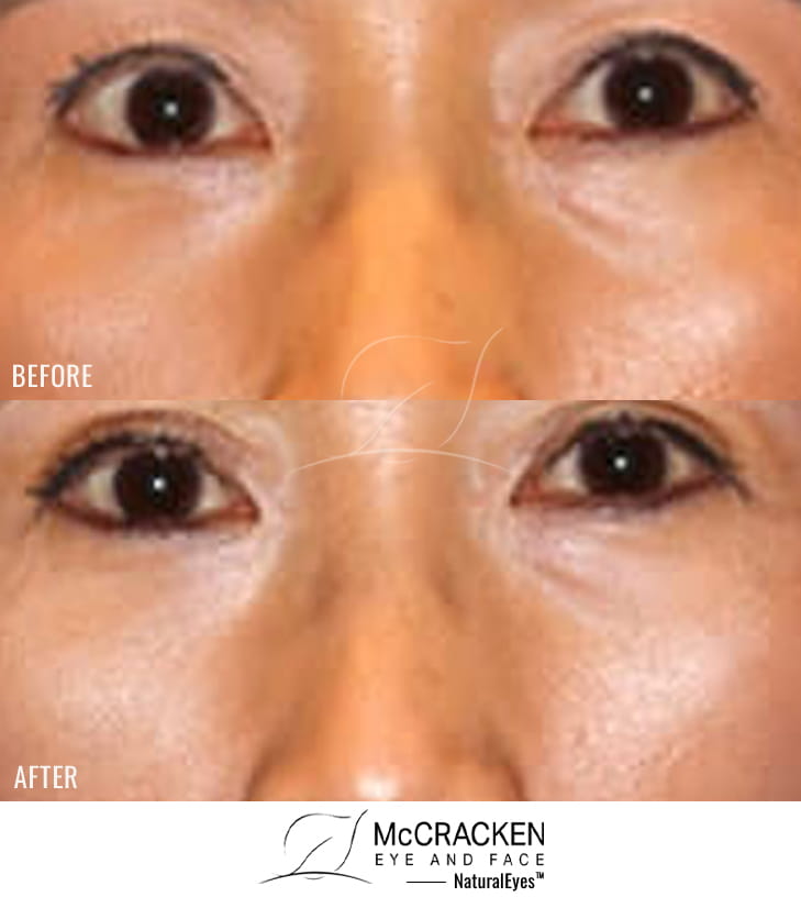 52 year old female – Upper Blepharoplasty