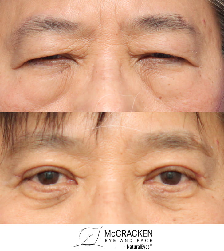 43 Year Old Female – Upper and Lower Lid Blepharoplasty with Injection of 4cc of Fat to Each Cheek. No Lower Lid Skin Incisions were made, and lower lid fat was excised and repositioned.