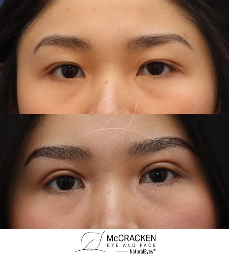 23 Year Old Female. Bilateral Upper Lid Westernizing Blepharoplasty. This patient wanted her eyelids to look more Western and less Asian. She has a small left upper lid scar from an attempt elsewhere to correct her lids with threading.