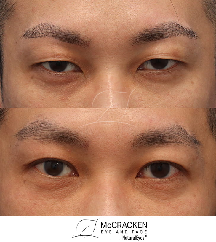 41 Year Old Male – Upper Blepharoplasty