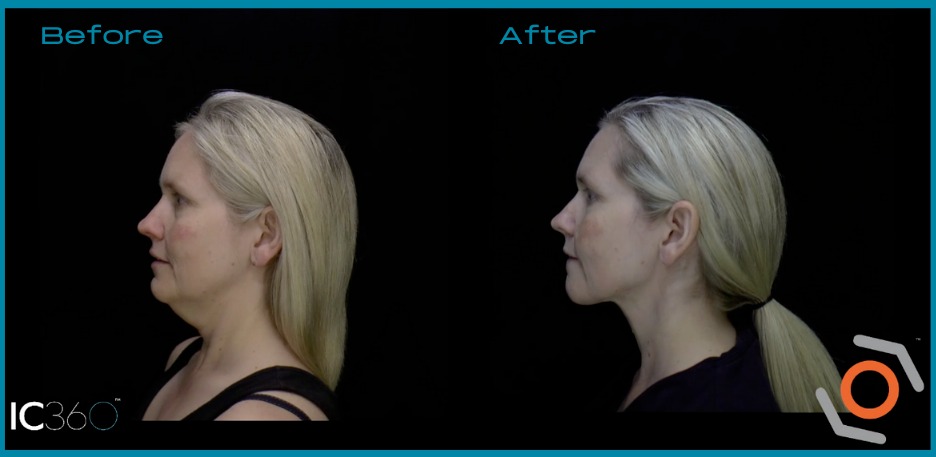 Neck rejuvenation before and after picture female patient left side view