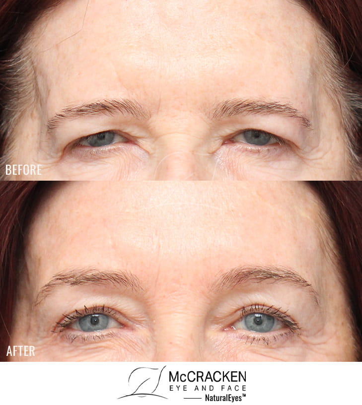 69 Year Old Female – Brow Lift via Hairline Incision. This patient did not desire an upper blepharoplasty, so no upper lid skin was removed. Lifting the brow did elevate the upper lid skin and help with upper lid heaviness (although removing upper lid skin would have opened the eyes up more).