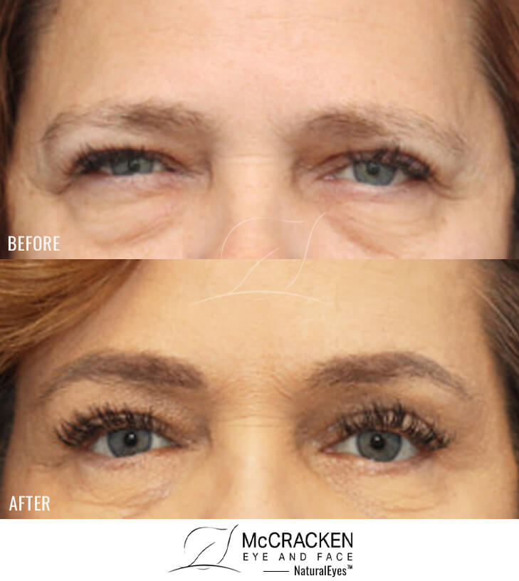 62 Year Old Female – Endoscopic Brow Lift with Right upper Lid Fat Removal, Lower Blepharoplasty and Laser Skin Resurfacing. The brow lift was fixated with EndoTines. No lower lid skin incisions were made.