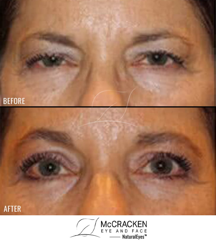 58 Year Old Female – Endoscopic Brow Lift with Upper and Lower Blepharoplasty