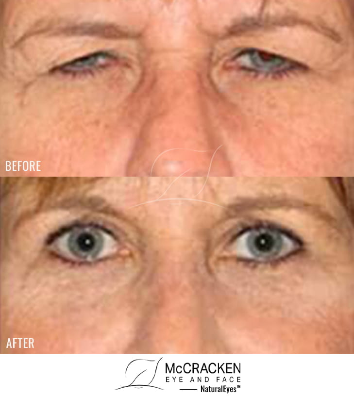 51 Year Old Female – Endoscopic Brow lift and Upper Blepharoplasty